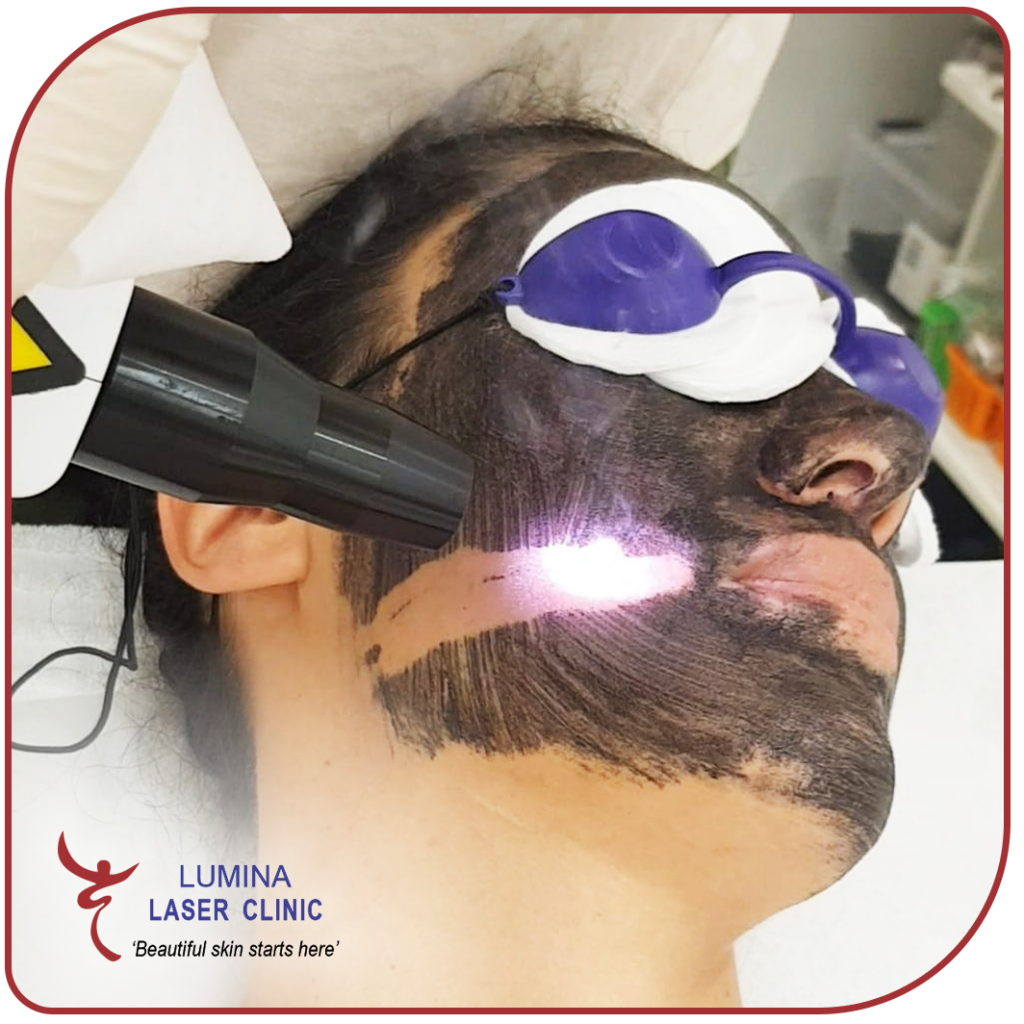 CHINA DOLL FACIAL/CARBON FACIAL Lumina Clinic in Hallam