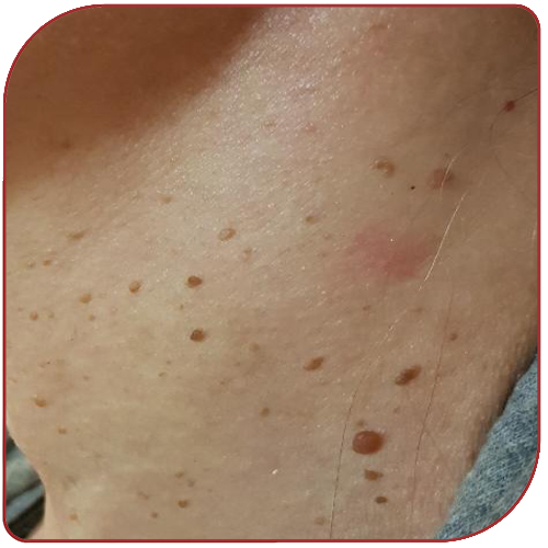 Skin Tag Removal before